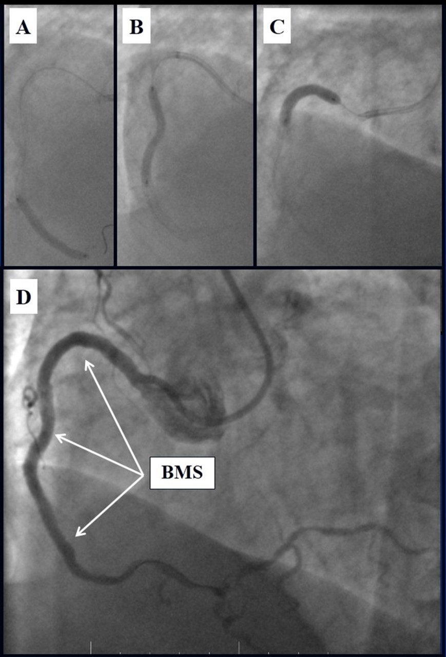 A, B, C - Stenting of the RCA with BMS; D - Angiography result.