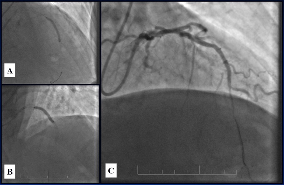 A, B - Stenting of the LAD with DES; C - Angiography result.