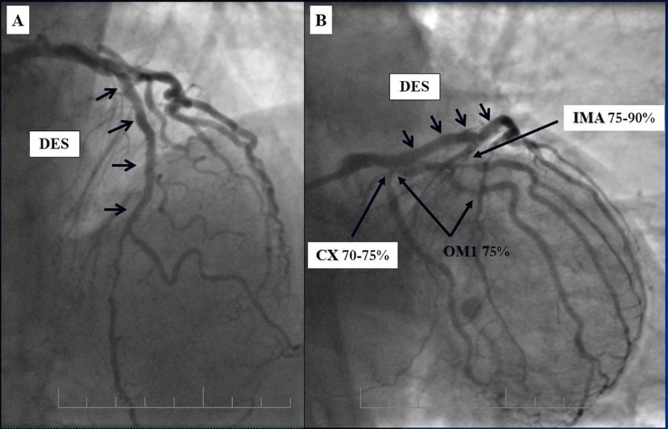 Patent stents in LAD; A – AP-cranial 30° projection, B – Right anterior oblique 20°/caudal 20° projection.