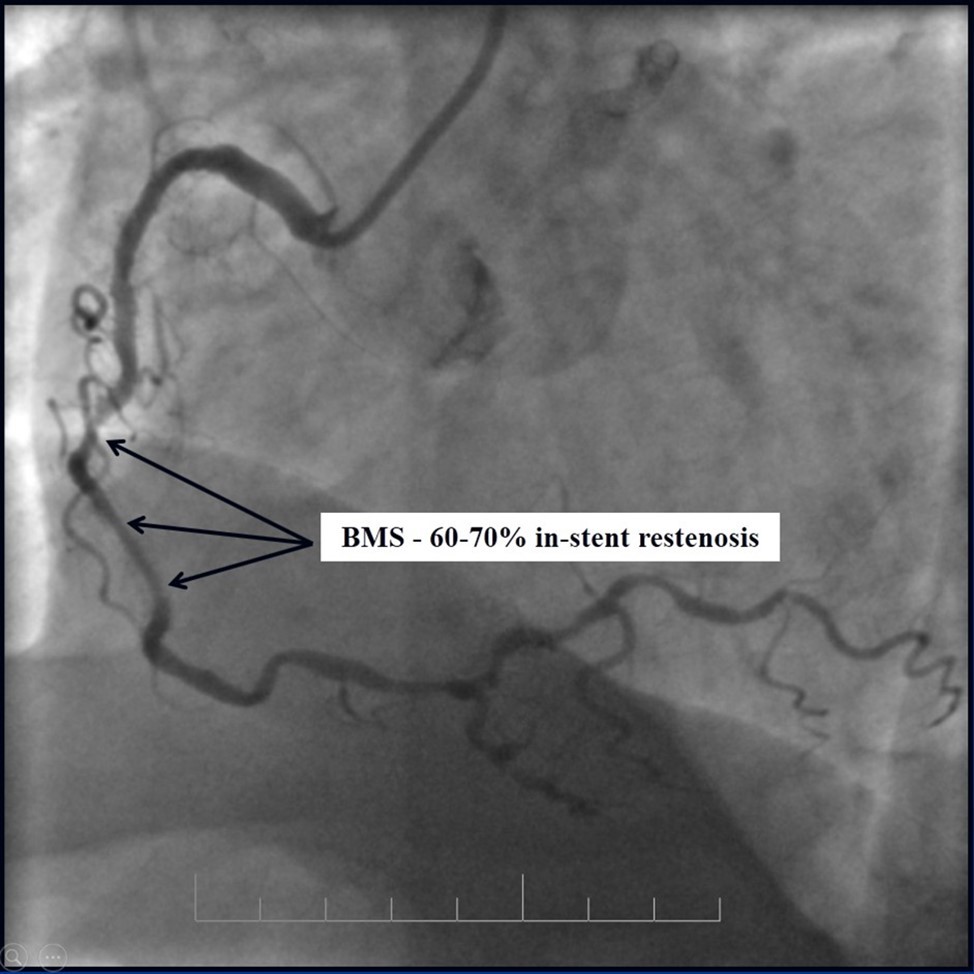 RCA, 60-70% in-stent restenosis in BMS