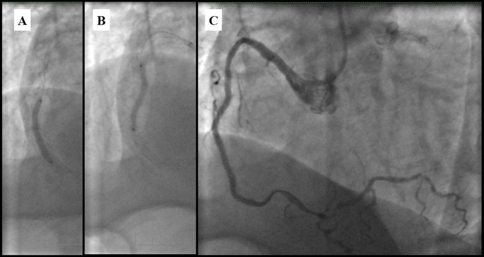 RCA; A, B  - Plain old balloon angioplasty; C - Angiography result.