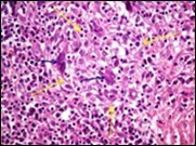 Granulomatous mastitis with scattered langhans and foreign body giant cells, epitheloid cell granuloma and lymphoid ingress11.