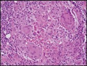 Granulomatous mastitis with epitheloid cell granuloma, langhans and foreign body giant cells with lymphocytic rimming12.