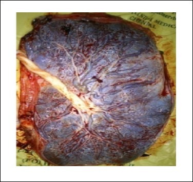 Oval Shape placenta (Photographed)