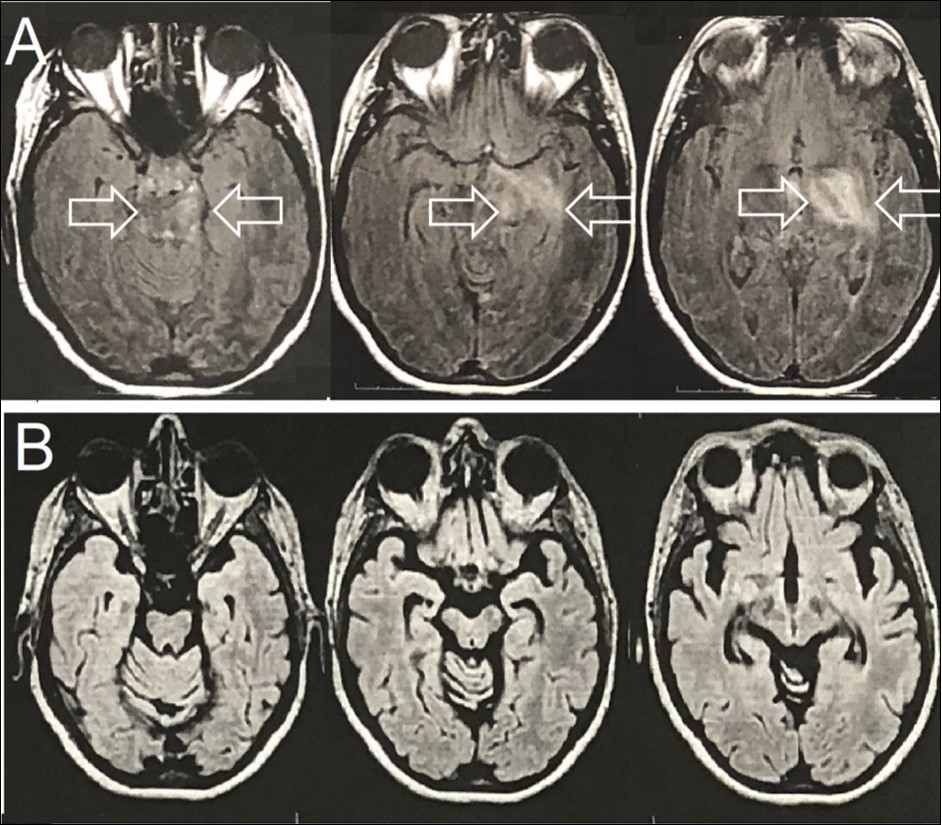 Brain Axial-FLAIR-MRI- (A) Expansive mass lesion with hyperintense signal in the left capsular nucleus region, with mesencephalic extension and enhancement by the paramagnetic agent (white arrows). (B) Complete improvement of the expansive mass lesion with the presence of brain atrophy.