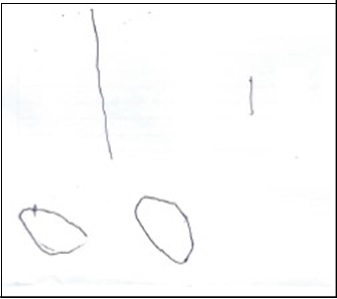 After treatment, the boy showed                                  improvement in his ability to hold the pen as could draw a more straight line