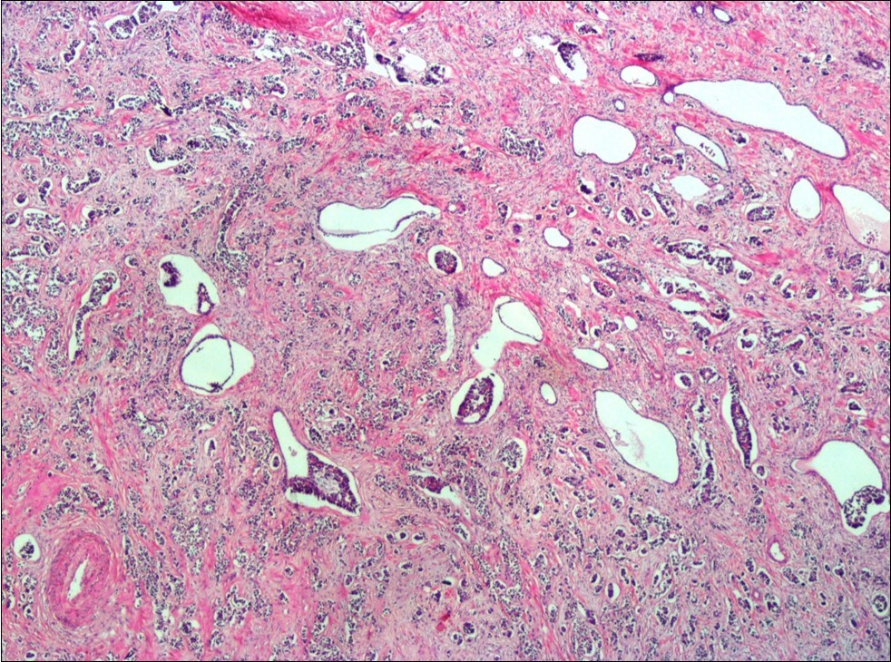 Infiltration of the tumor cells between prostatic ducts (H&E, x40)