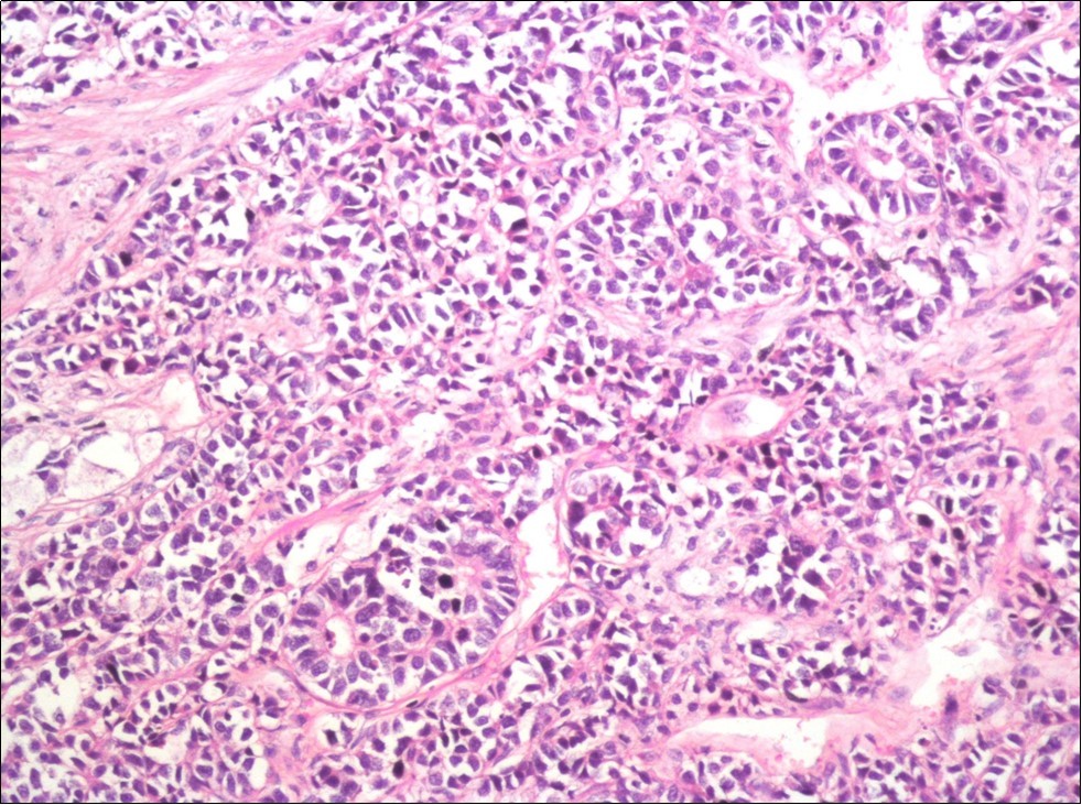 The tumor cells show rosette formation with hyperchromatic nuclei and nuclear molding (H&E, x200)