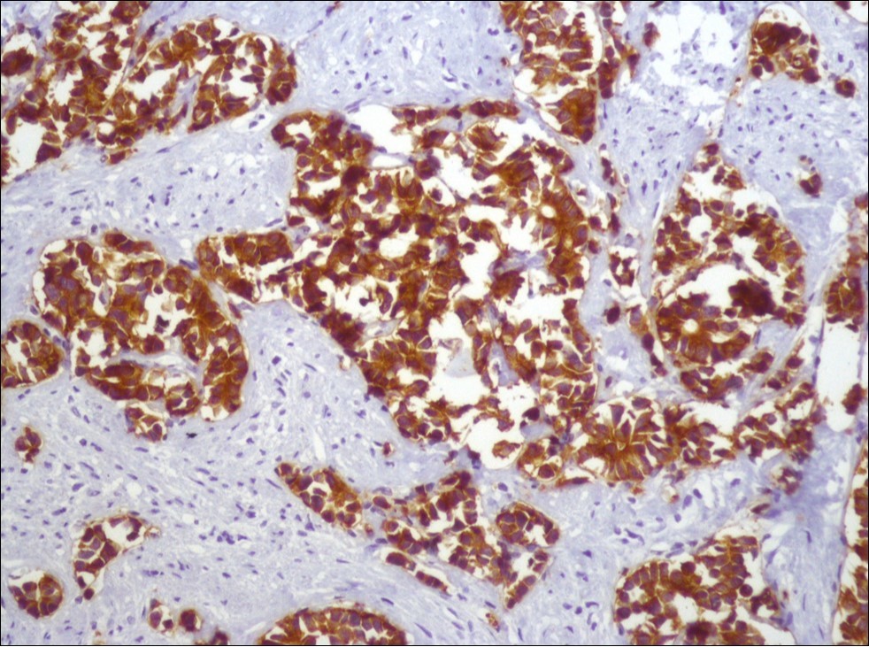 Diffusely and strong immunostaining for synaptophysin (Synaptophysin, x200)