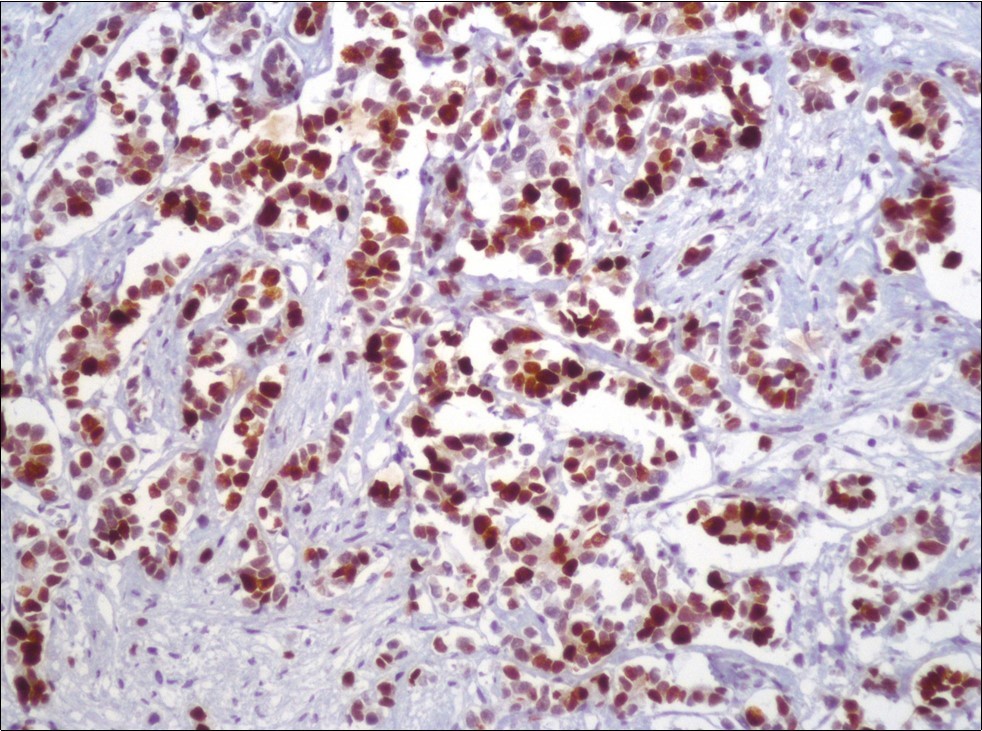 High Ki67 proliferative index (Ki-67, x200)