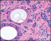 Desmoplastic trichoepithelioma demonstrating aggregates of basaloid cells with numerous keratinous horn cysts               interspersed in an intensely fibrotic                  stroma 9.