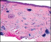 Desmoplastic trichoepithelioma               delineating cords and nests of basaloid cells, few horn cysts and a circumscribing fibrotic stroma 9.