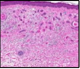 Desmoplastic trichoepithelioma    exhibiting accumulated basaloid epithelial cells disseminated amongst a background of abundant fibrous tissue stroma and an            attenuated superimposed epidermis 10.