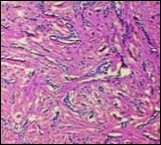 Desmoplastic trichoepithelioma depicting cords and aggregates of basaloid epithelial cells with encompassing dense, compact fibrous tissue stroma 11.