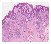 Desmoplastic trichoepithelioma               enunciating several horn cysts, nests of basaloid cells, an enveloping desmoplastic stroma and thinned out superimposed epithelium 12.