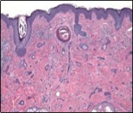 Desmoplastic trichoepithelioma displaying few horn cysts, nests of basaloid cells and an abundance of desmoplastic, fibrotic stroma with an attenuated squamous epithelial lining 13.