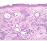 Desmoplastic trichoepithelioma                     exemplifying several keratinous horn cysts, nests of basaloid cells, a desmoplastic fibrotic stroma along with a thinned out squamous epithelial lining 14.