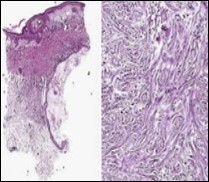 Desmoplastic fibrotic stroma                     demonstrating a thinned out, superimposed               epithelium, fibrotic stroma and a dispersal of basaloid cell cords and aggregates 15.