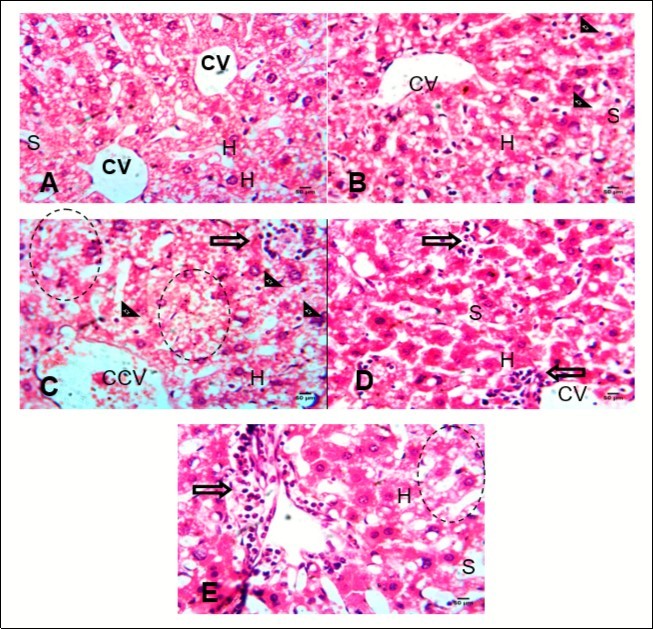 (A-E): Photomicrographs of Liver show the hepatic tissues composed of hepatocytes (H) disposed in sheet, the hepatocytes are seperated by the sinusoids (S). the central vein (CV) is well outlined in                     (A Control) Section is free from collections and inflamatory cells. (B)  Arrow head pointed to kuppfer cells, the central vein appear normal. (C) There was distruption of hepatic parenchyma (circle), increasd number of kuppfer cells (arrow head). (D) perivascular and interstitial infilteration of inflammatory cells (arrow). The hepatocyte (H) and sinusoids appear normal. (E) periportal inflammatory cell infilterate (arrow), marked      distruption of the hepatic parenchymal microanatomy (circle). H&E (x400)