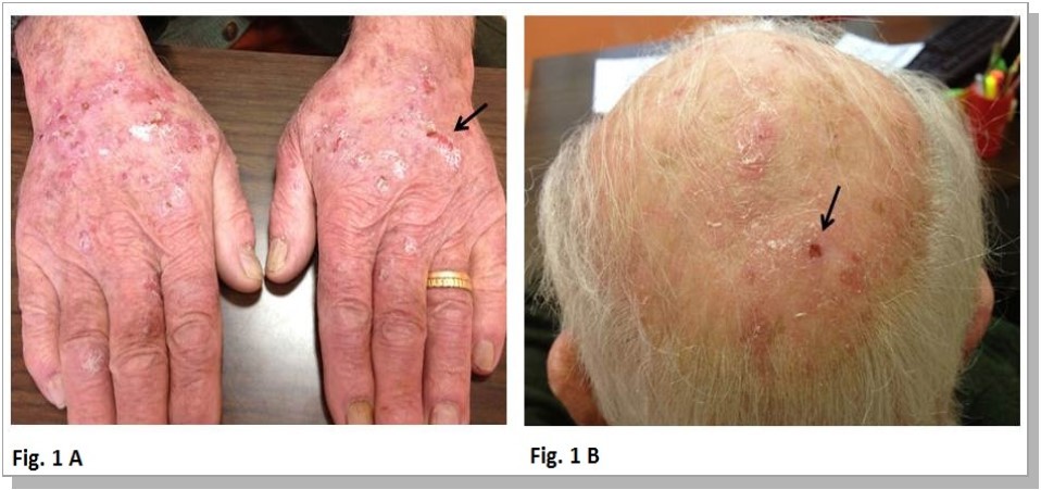 Erythematous ulcerative lesions with associated scratching lesionson hands (A) and multiple actinic keratosis on sun-damaged skin (B) (black arrows).