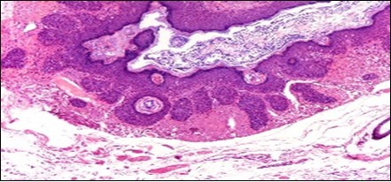 Nevus comedonicus with grouped, dilated follicular ostia,           impacted with keratin and a layering of hyperkeratotic stratified squamous          epithelium11.