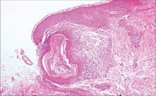 Nevus comedonicus depicting an impacted, distended follicular ostium, keratinous aggregation and a                  superimposed, acanthotic, hyperkeratotic, stratified squamous epithelium17.