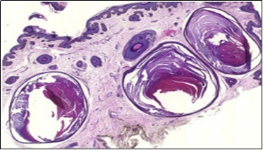 Nevus comedonicus  with         aggregated follicular ostia, lamellated keratin, hyperkeratotic stratified           squamous epithelial lining  and an          attenuated superimposed epithelium12.