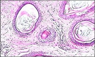 Nevus comedonicus with distended follicular ostia, keratin       accumulation, hyperkeratotic epithelial lining  and intervening loose           fibro-connective tissue13.