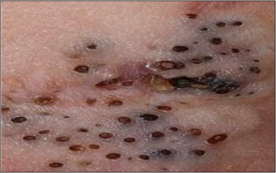Nevus comedonicus clinically demonstrating darkly-stained, grouped, distended, follicular ostia, plugged with keratin, demonstrating a honey-comb pattern14.