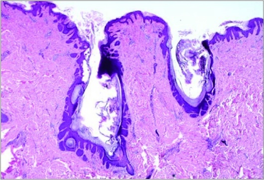 Nevus comedonicus        delineating dilated, plugged, follicular ostia, keratinous substance and a layering with a hyperkeratotic,             stratified squamous epithelium[15.