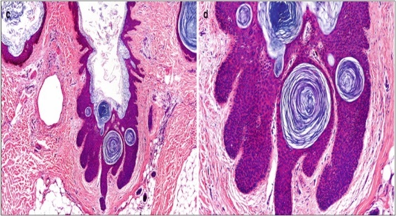 Nevus comedonicus with an aggregation of dilated, plugged           follicular ostia, keratinous flakes and an intensely hyperkeratotic stratified          squamous epithelial layer16.
