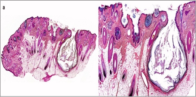 Nevus comedonicus exhibiting          aggregates of distended follicular ostia,           keratin plugging and a lining of                      hyperkeratotic stratified squamous              epithelium16.