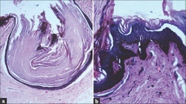 Nevus comedonicus exemplifying a dilated, plugged follicular ostium, keratinous flakes and a layer of stratified squamous  epithelium17.