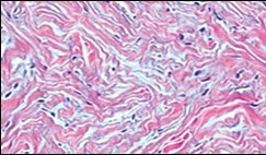 Soft tissue perineurioma with fascicles of bipolar neural cells with elongated cytoplasmic processes, wavy nuclei  and an admixture of                 collagen fibres 11.