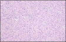 Soft tissue perineurioma with whorls of neural cells delineating spindle cells with bipolar        cytoplasm and wavy nuclei and an admixture of                collagen bundles 19.
