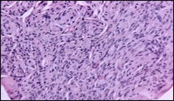 Soft tissue perineurioma with lamellar bundles of neural cells demonstrating elongated cytoplasmic processes, wavy,  slender nuclei and admixed collagen fibres 12.