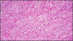 Soft tissue perineurioma /schwannoma with whorls and lamellae of neural cells with               bipolar cytoplasmic processes, wavy nuclei and intermingled collagen fibres 14.