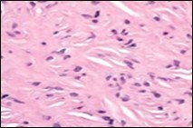 Soft tissue perineurioma with an           abundance of collagen fibrils intermixed with a       neural element with bipolar cells with elongated cytoplasm and wavy nuclei 16.