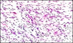 Soft tissue perineurioma with neural cells exemplifying elongated cytoplasmic processes,          slender, wavy nuclei  and an abundance of          collagenous stroma 17.