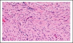 Soft tissue perineurioma with plentiful                collagenous fibrils intermixed with lamellar neural tissue with elongated cytoplasmic extensions and wavy, pointed  nuclei 18.