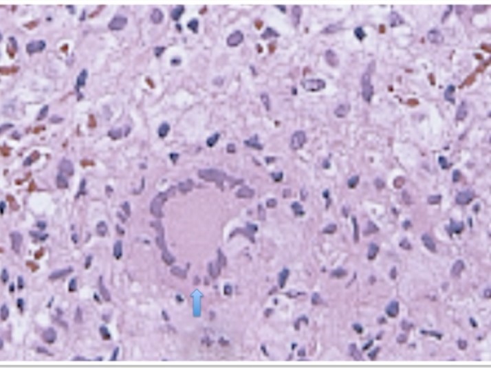 Hepatic histopathology of patient showing granuloma