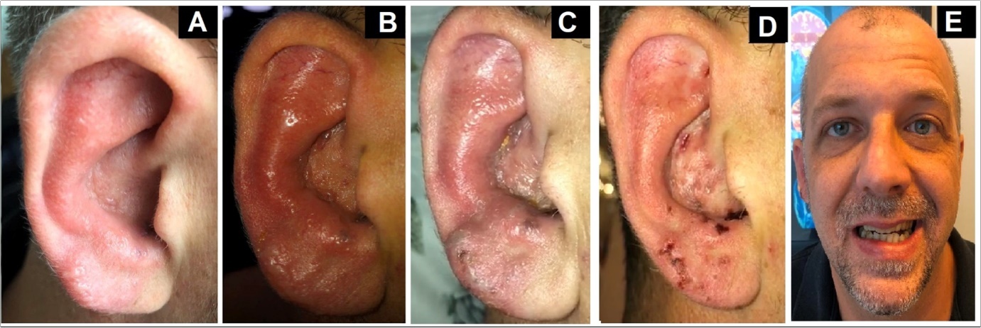 Right Auricle varicella zoster vesicles. (A) Third day of clinical evolution (B) Seventh day of clinical evolution  (C) Tenth day of clinical evolution (D) Fifteenth day of clinical evolution (E) Right facial nerve                  paralysis- House Brackmann scale grade II.