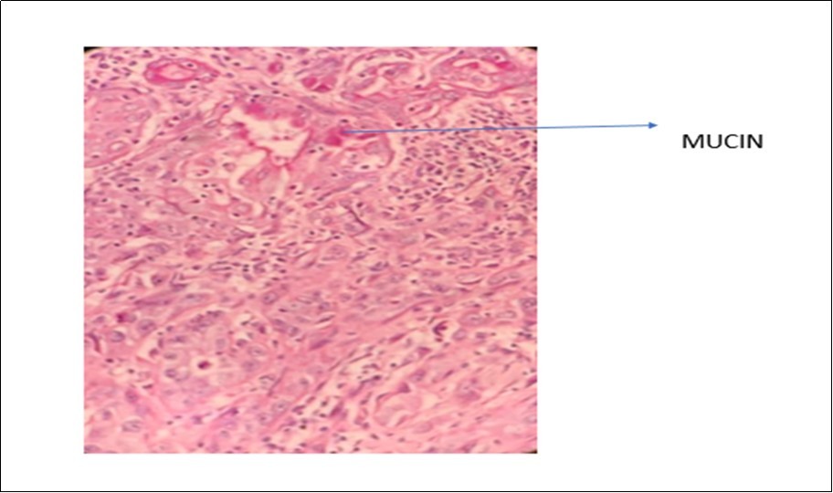 Photomicrograph show presence of mucin with positivity of mucicarmine stain in MEC of larynx (x40 high power field)