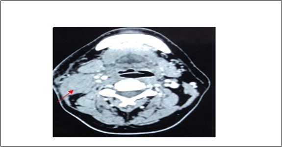 Contrasted CT neck showing mass at deep lobe of right parotid gland