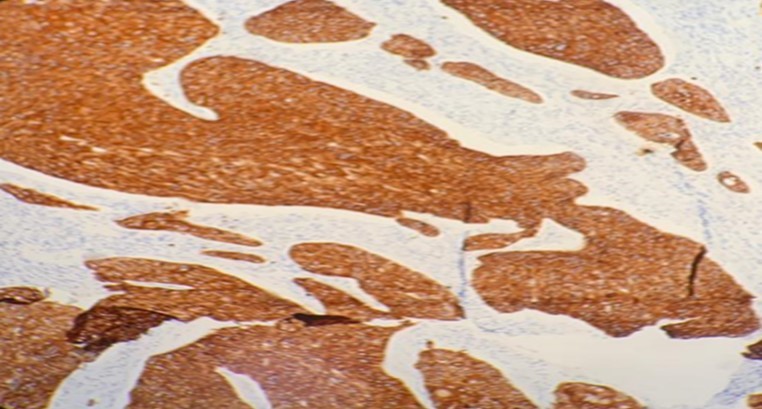 Photomicrograph show positivity to immunohistochemistry marker CK 5/6 in SCC of parotid   (x20 high power field)