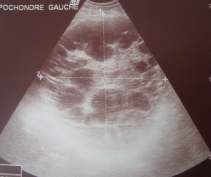 Ultrasonography showing a 20 cm multivesicular cystic mass of spleen