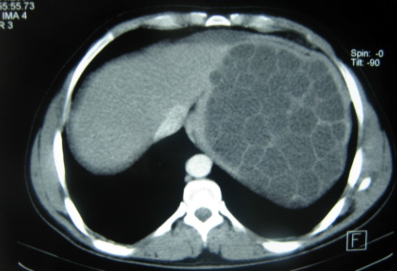 CT showing a huge single 20×16×18cm cystic mass located in the spleen