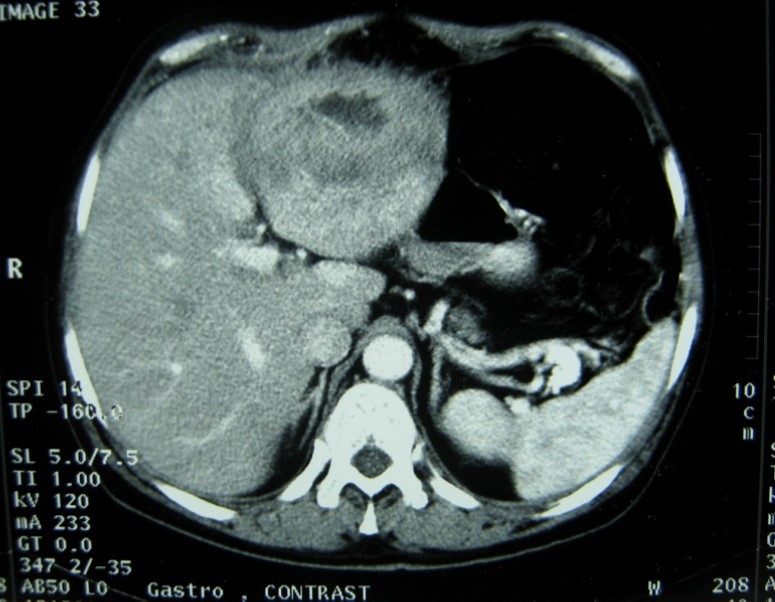 CT showing a huge single 20×16×18cm cystic mass located in the spleen