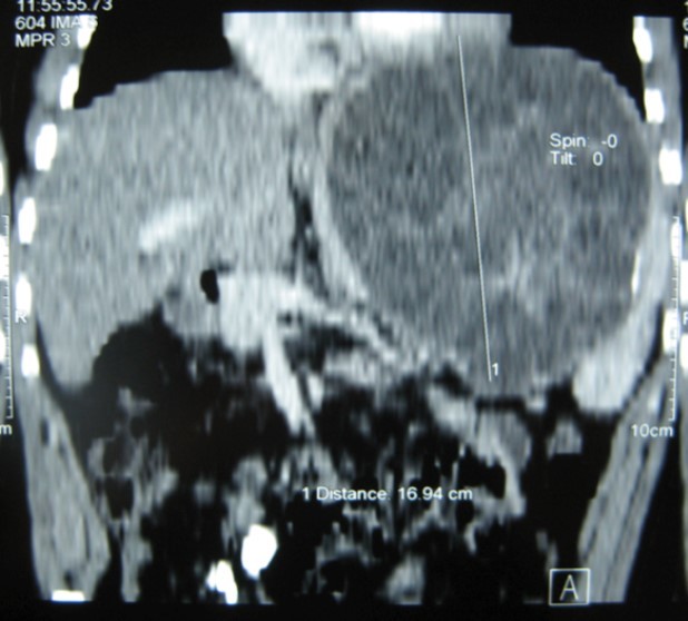 CT showing a huge single 20×16×18cm cystic mass located in the spleen