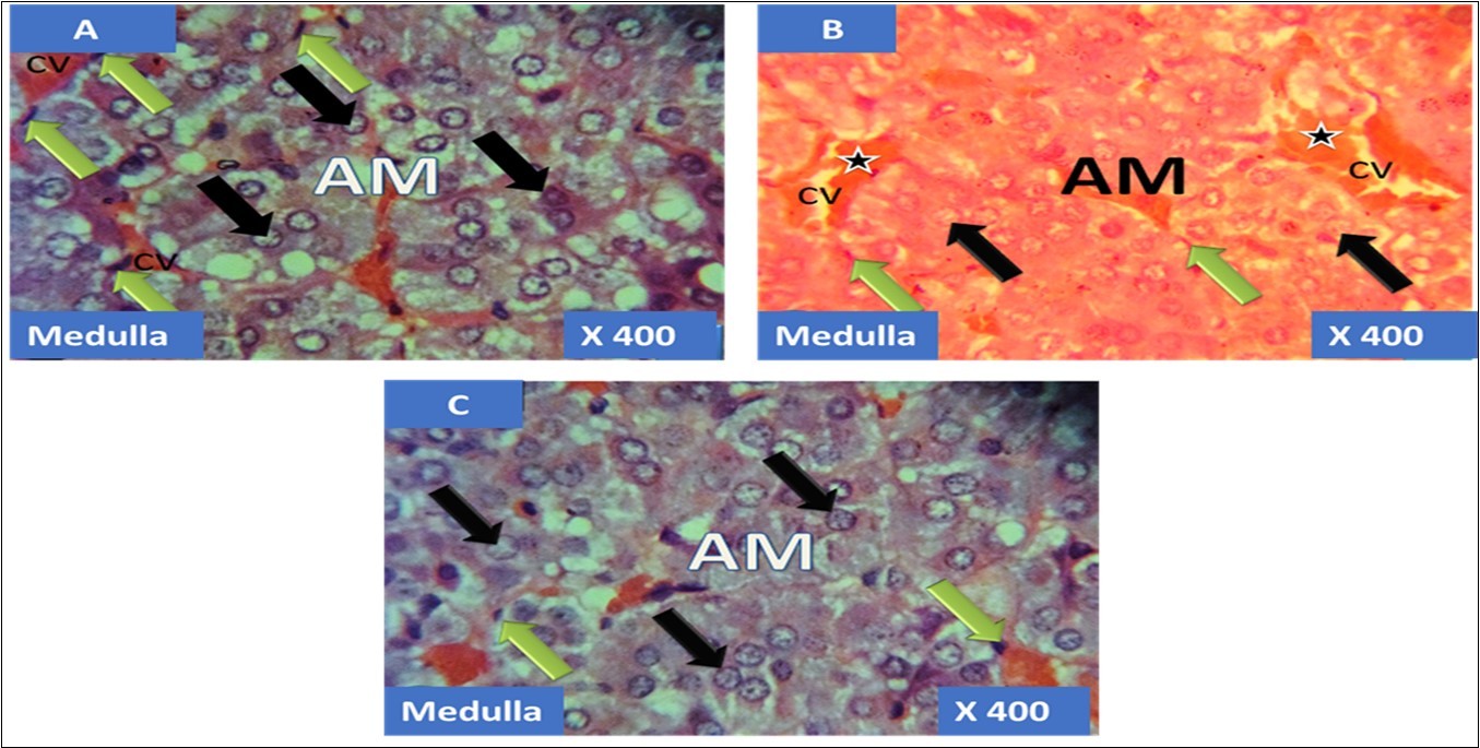 showing the cellular layer of medulla of Adrenal gland group A (control), group B (T1) and group C (T2). The evenly distributed normal chromaffin cells (black arrows) and the ganglion nerve cells (green arrows) accompanying the central vein (CV) in A. Evenly distributed distorted and pyknotically appearing chromaffin cells (black arrows) and the obliterated ganglion nerve cells (green arrows) with enlareged central vein (CV) having haemorrhagic necrosis sites(black stars) in B. normal chromaffin cells (black arrows) and the ganglion nerve cells (green arrows) with central vein (CV) in C. H&E x400